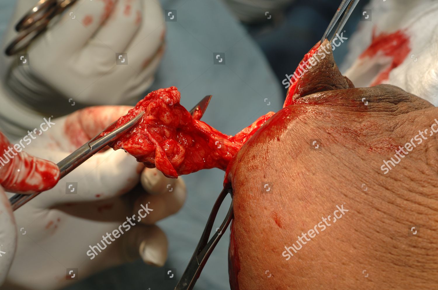 Model Released Surgeon Dissecting Through Breast Editorial Stock Photo