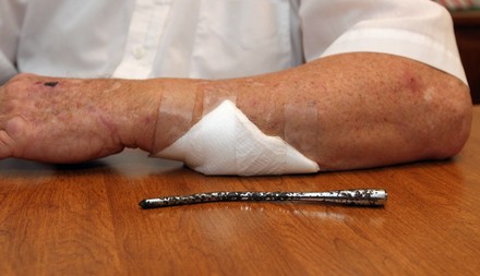 Man has metal removed from arm after accident in 1963, Granite City, Illinois, United States - 02 Jan 2015