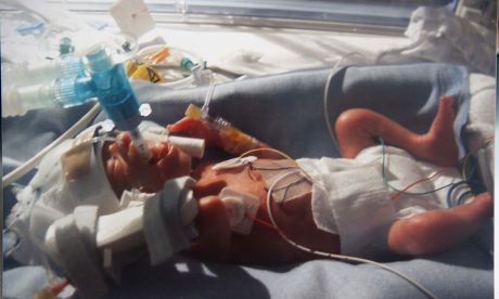 __COUNT__ Baby born 15 weeks premature celebrates first birthday ...