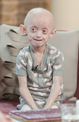 72 Progeria Stock Pictures, Editorial Images and Stock Photos ...