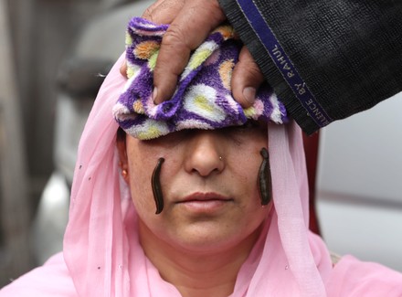 Leeches Suck Blood Womans Face During Editorial Stock Photo - Stock ...