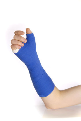 Model Released Wrist Cast Editorial Stock Photo - Stock Image 