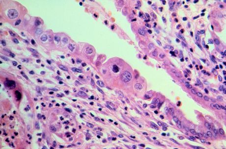 16 Adenocarcinoma Stock Pictures, Editorial Images and Stock Photos ...