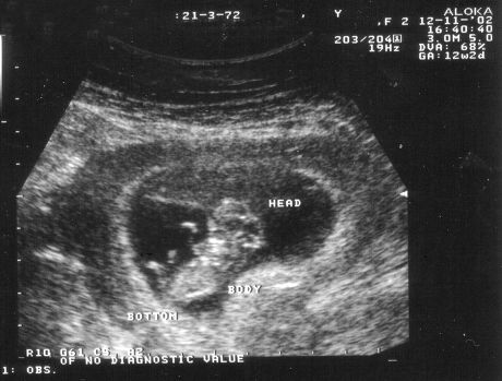 12 Week Ultrasound Scan Foetus Editorial Stock Photo - Stock Image ...