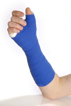 Model Released Wrist Cast Editorial Stock Photo - Stock Image ...