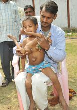 Eight Limbed Boy Deepak Kumar Father Redakční stock fotografie – stock snímek | Shutterstock