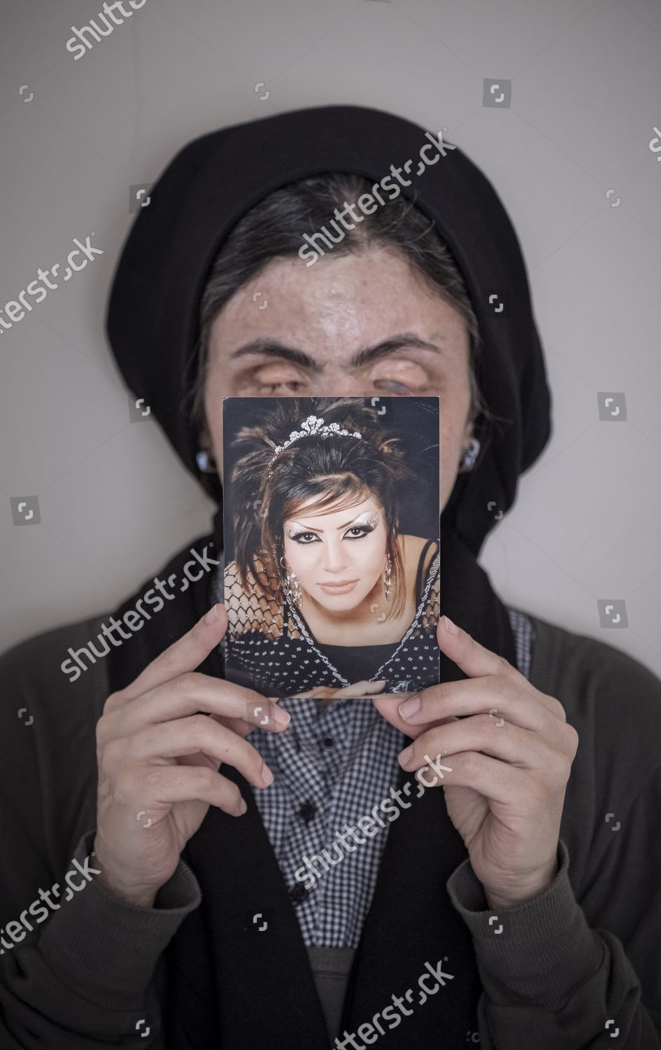 Masoumeh Ataei Who Victim Acid Attack Editorial Stock Photo - Stock ...