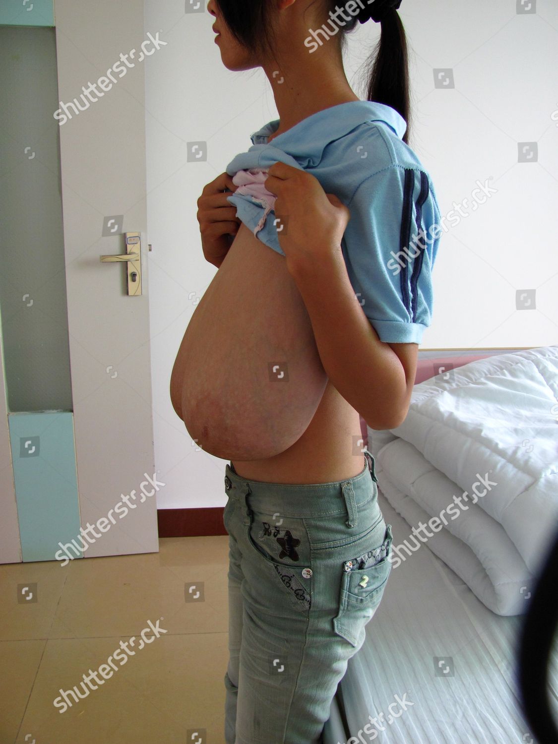 Xiao Wei Before Undergoing Breast Reduction Editorial Stock Photo - Stock  Image | Shutterstock