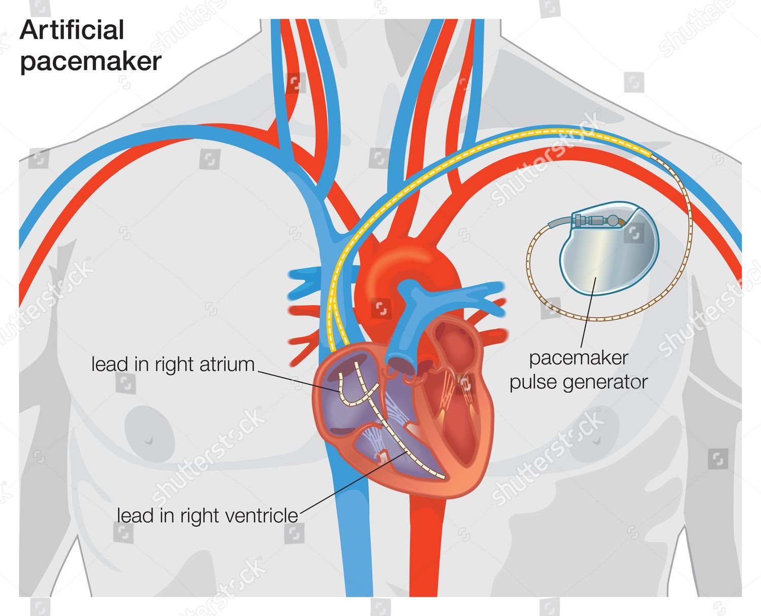 diagram-artificial-pacemaker-editorial-stock-photo-stock-image