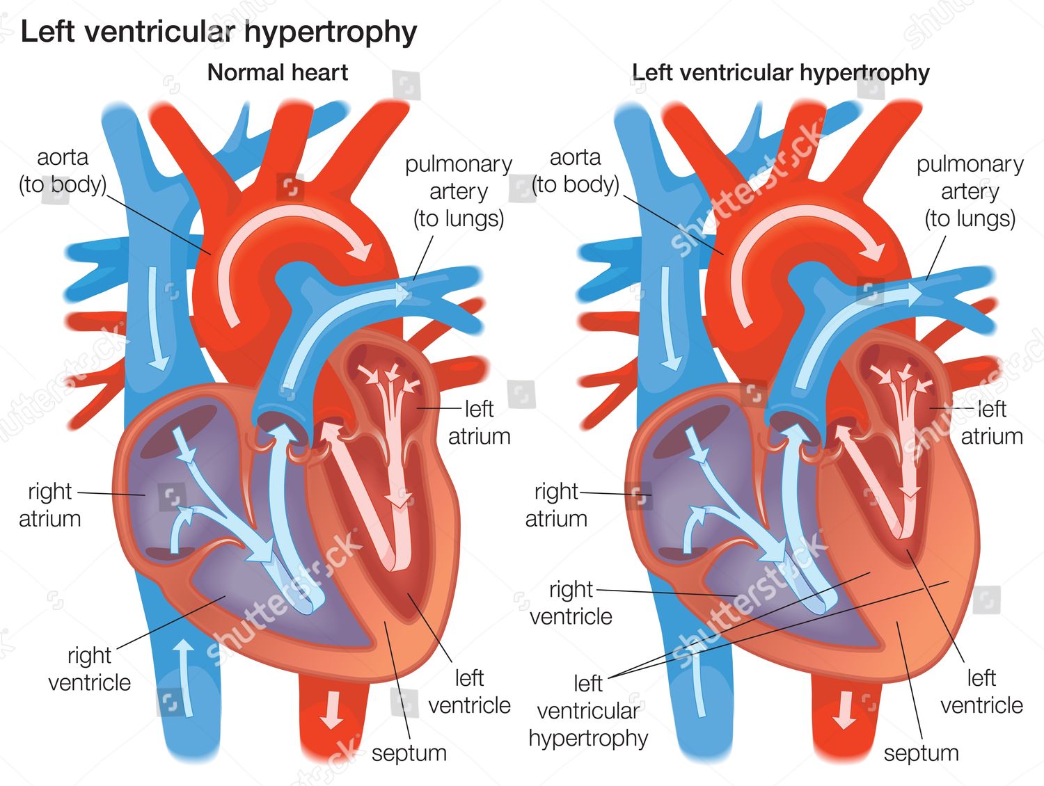 Cross Section Comparing Left Ventricular Wall Editorial Stock Photo ...