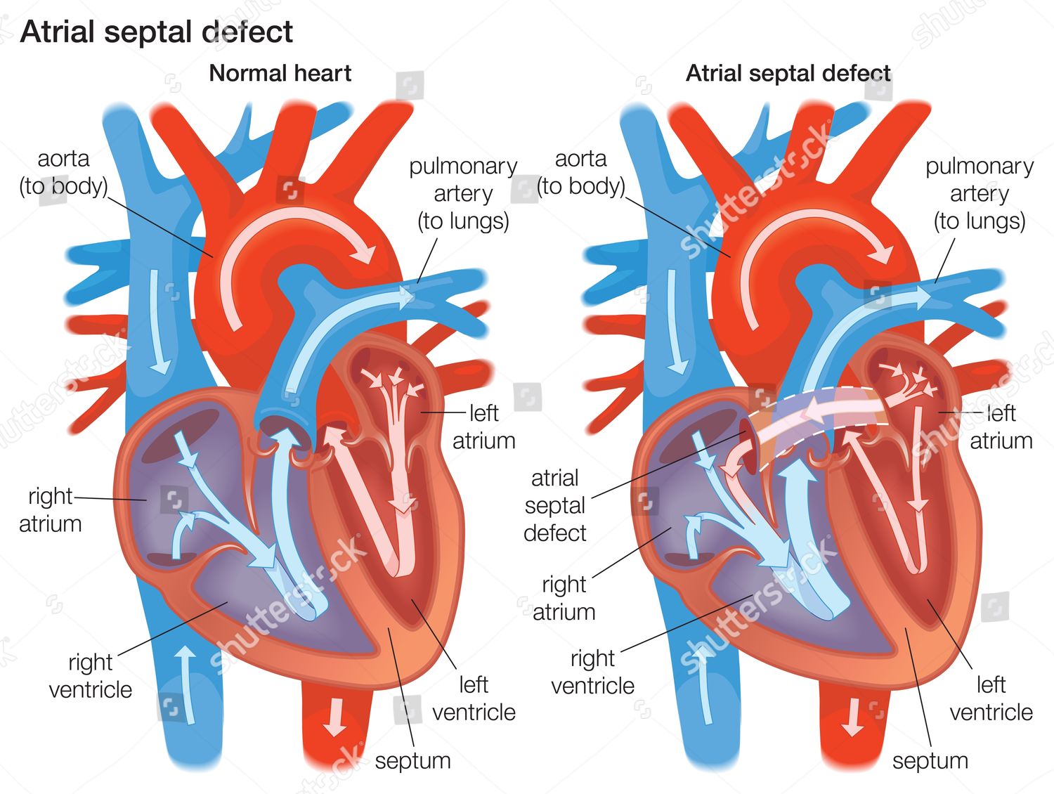 Diagram Demonstrating Difference Between Normal Heart Editorial Stock ...