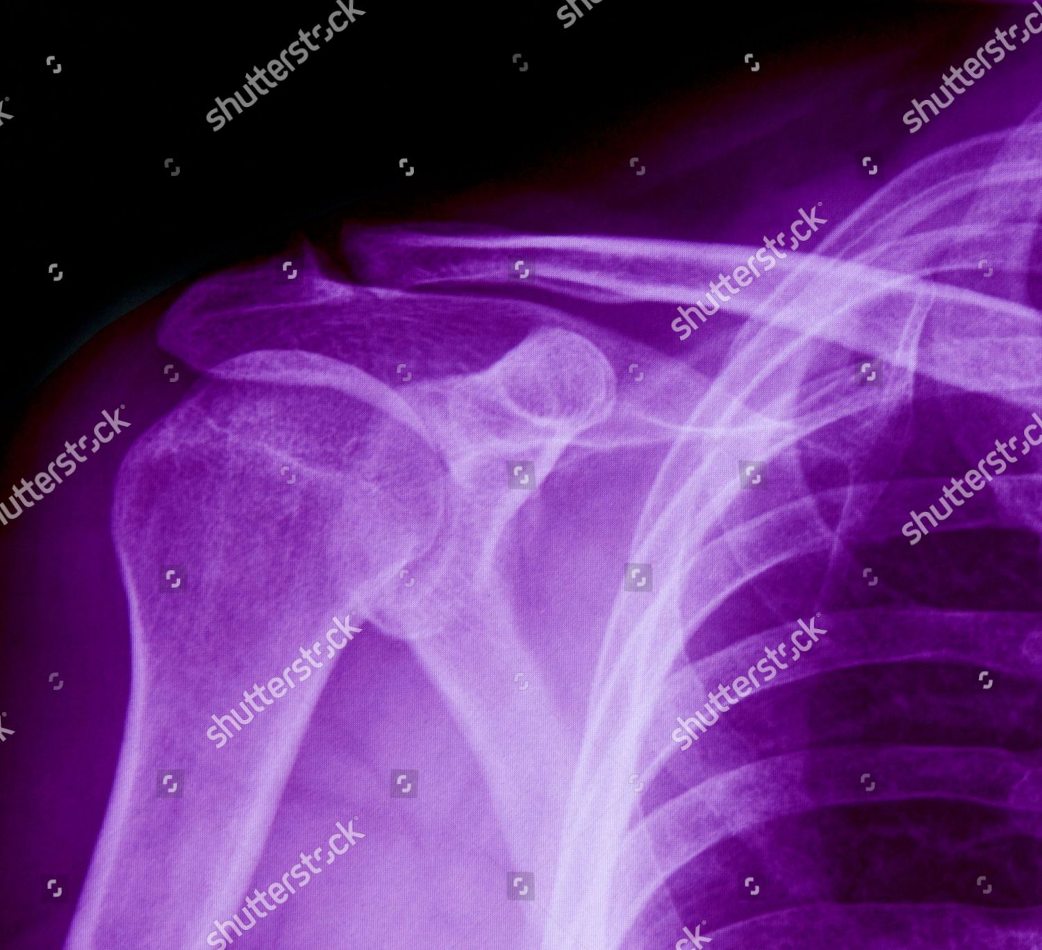 Shoulder X Ray Editorial Stock Photo Stock Image Shutterstock