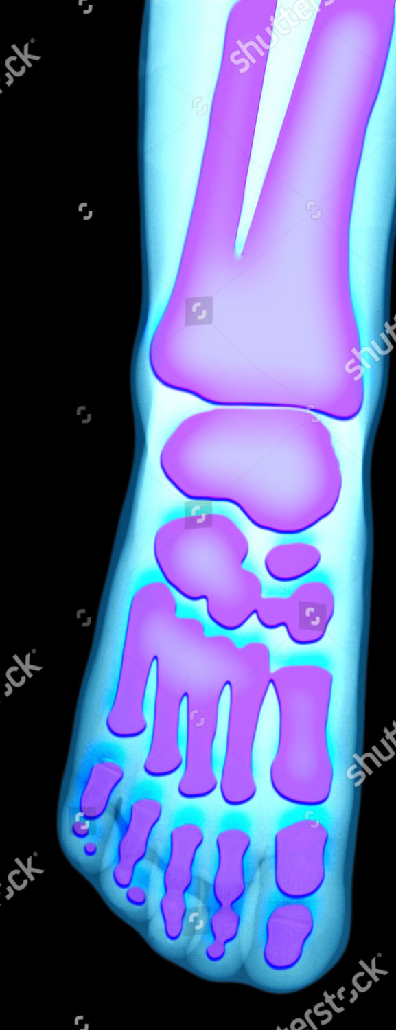 Foot X Ray Editorial Stock Photo Stock Image Shutterstock
