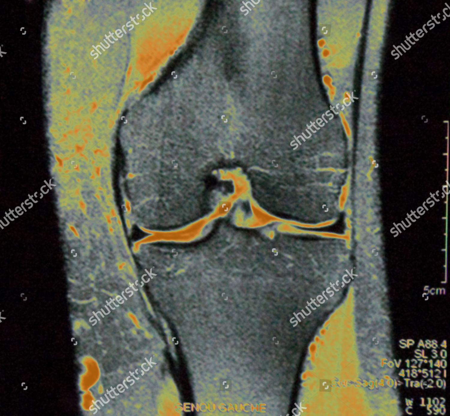 Knee Mri Editorial Stock Photo - Stock Image | Shutterstock