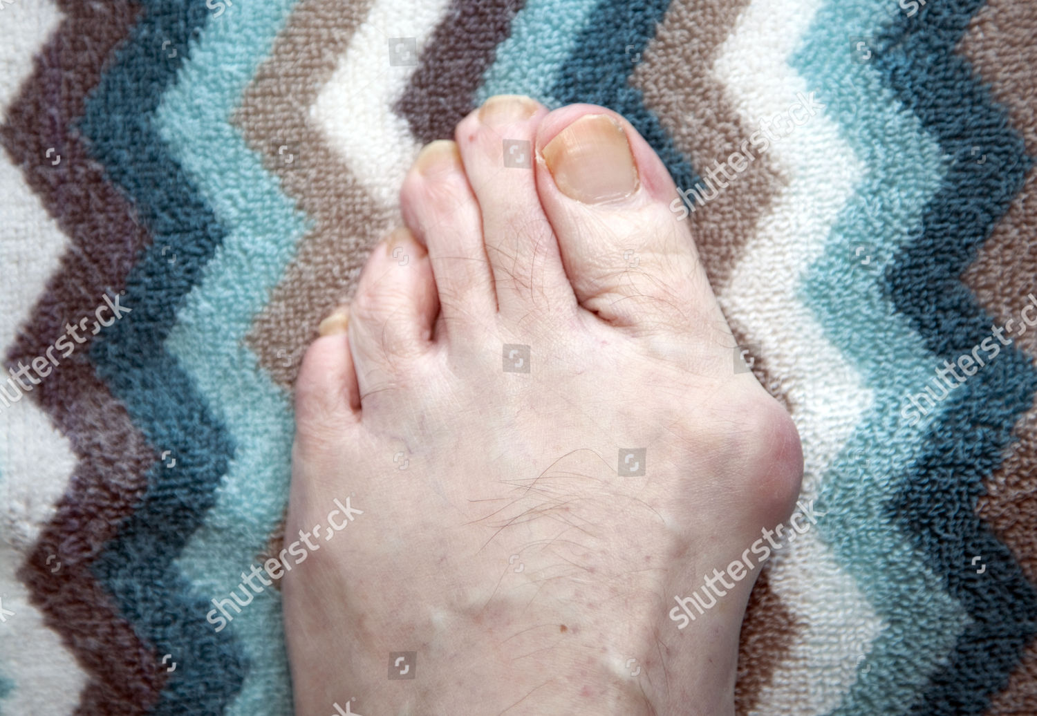 Bunion Stock Pictures Editorial Images And Stock Photos Shutterstock