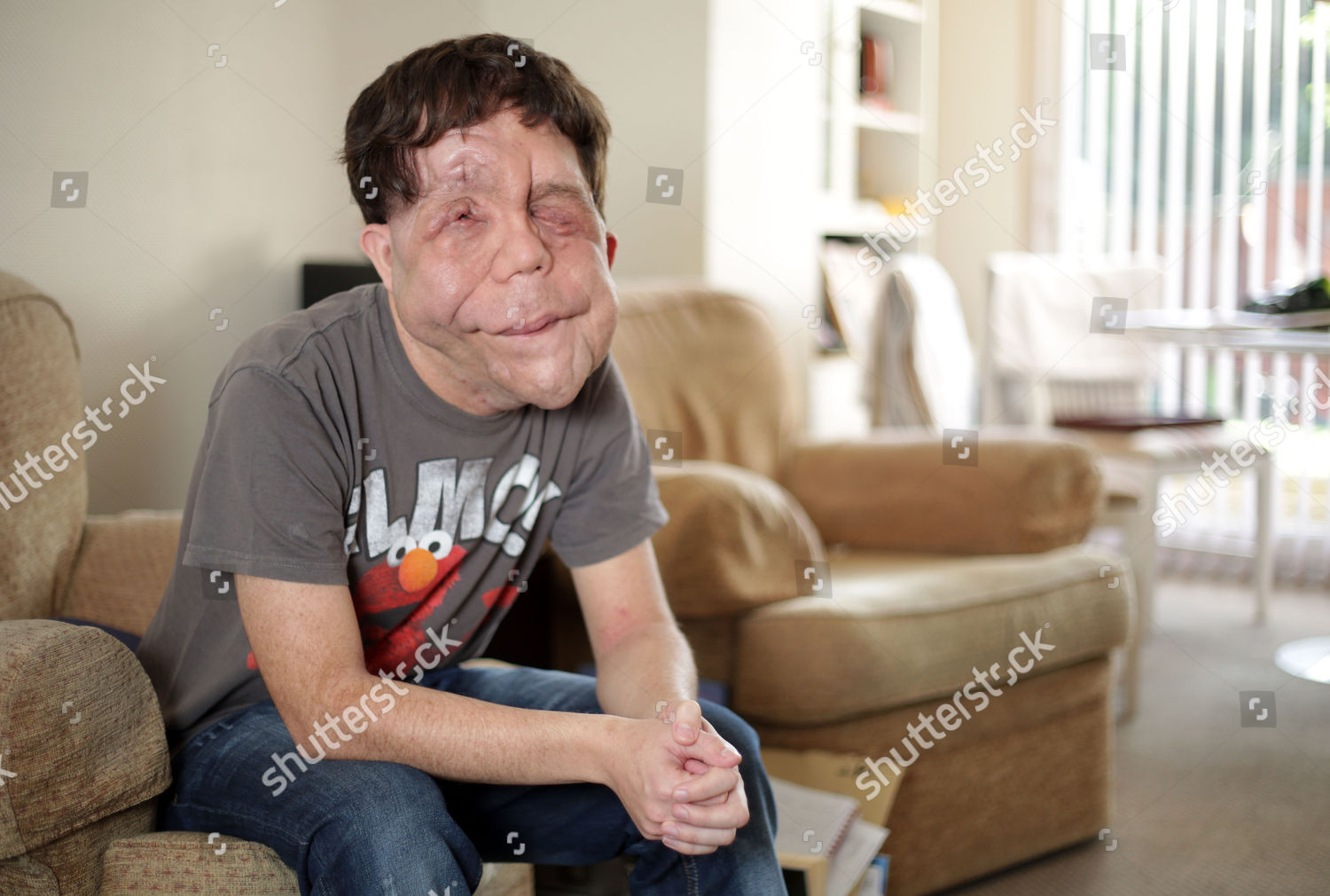 Adam Pearson Who Lives Neurofibromatosis Which Editorial Stock Photo ...