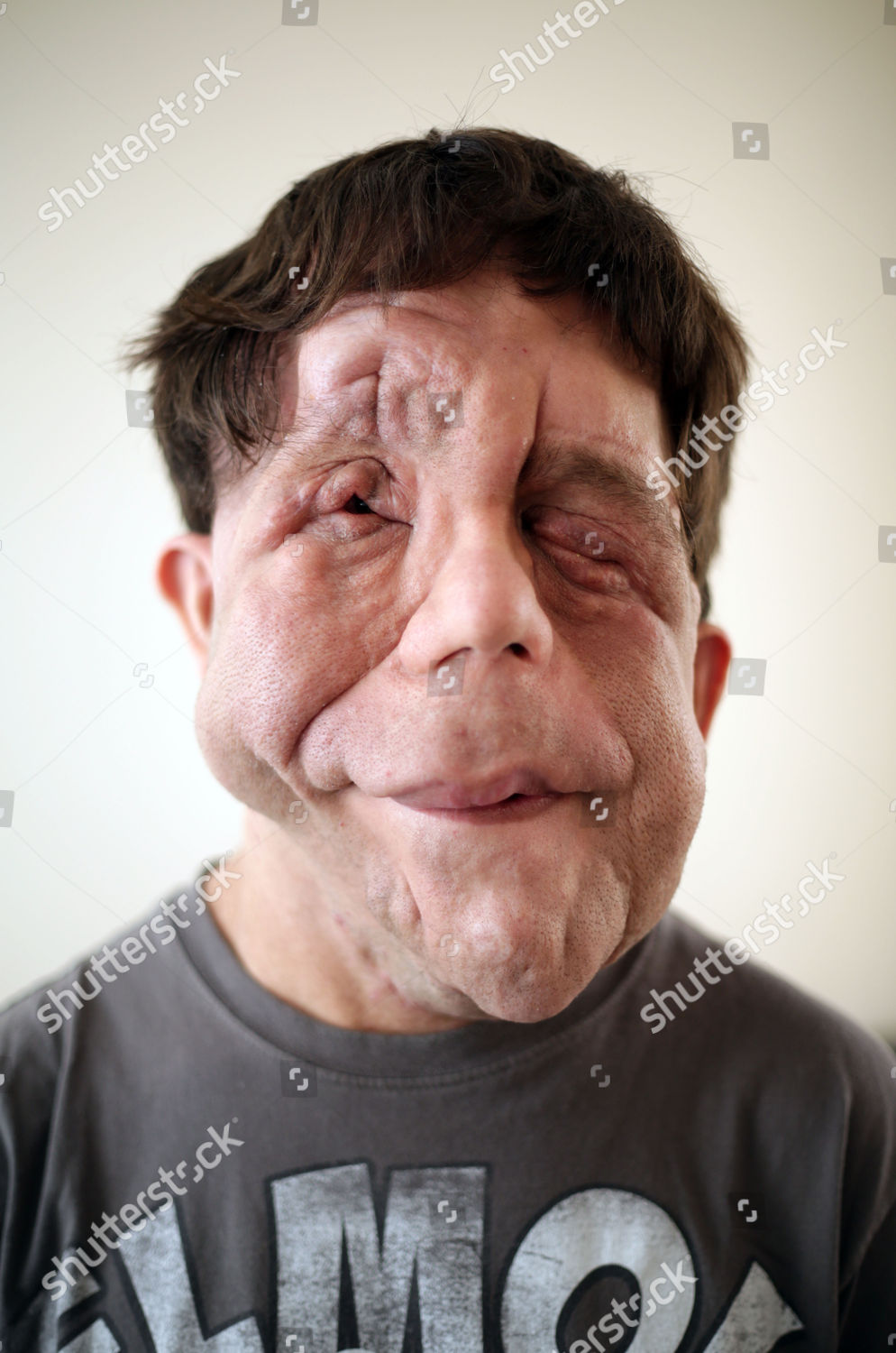 Adam Pearson Who Lives Neurofibromatosis Which Has Editorial Stock Photo Stock Image Shutterstock