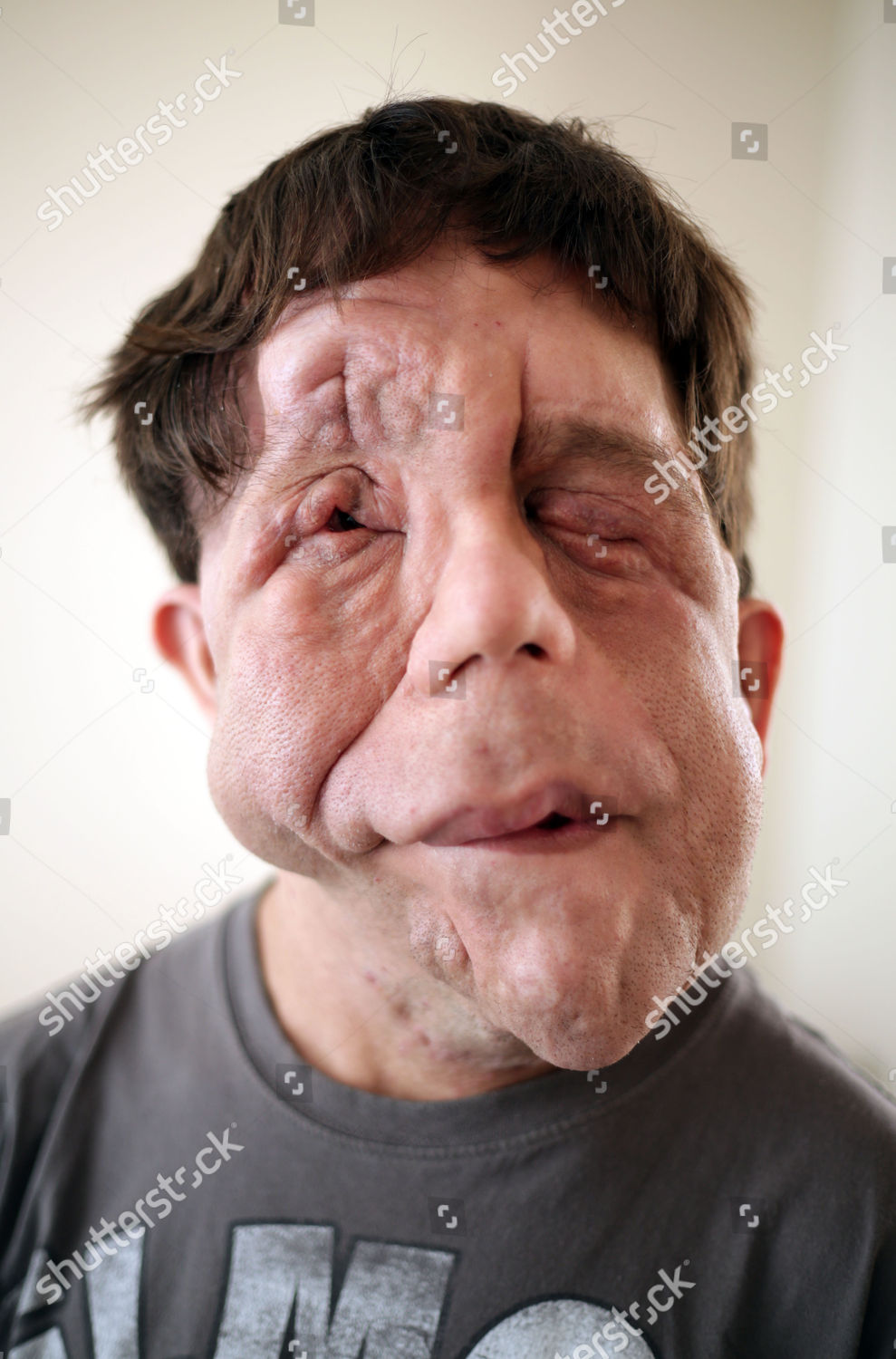 Adam Pearson Who Lives Neurofibromatosis Which Has Editorial Stock Photo Stock Image Shutterstock