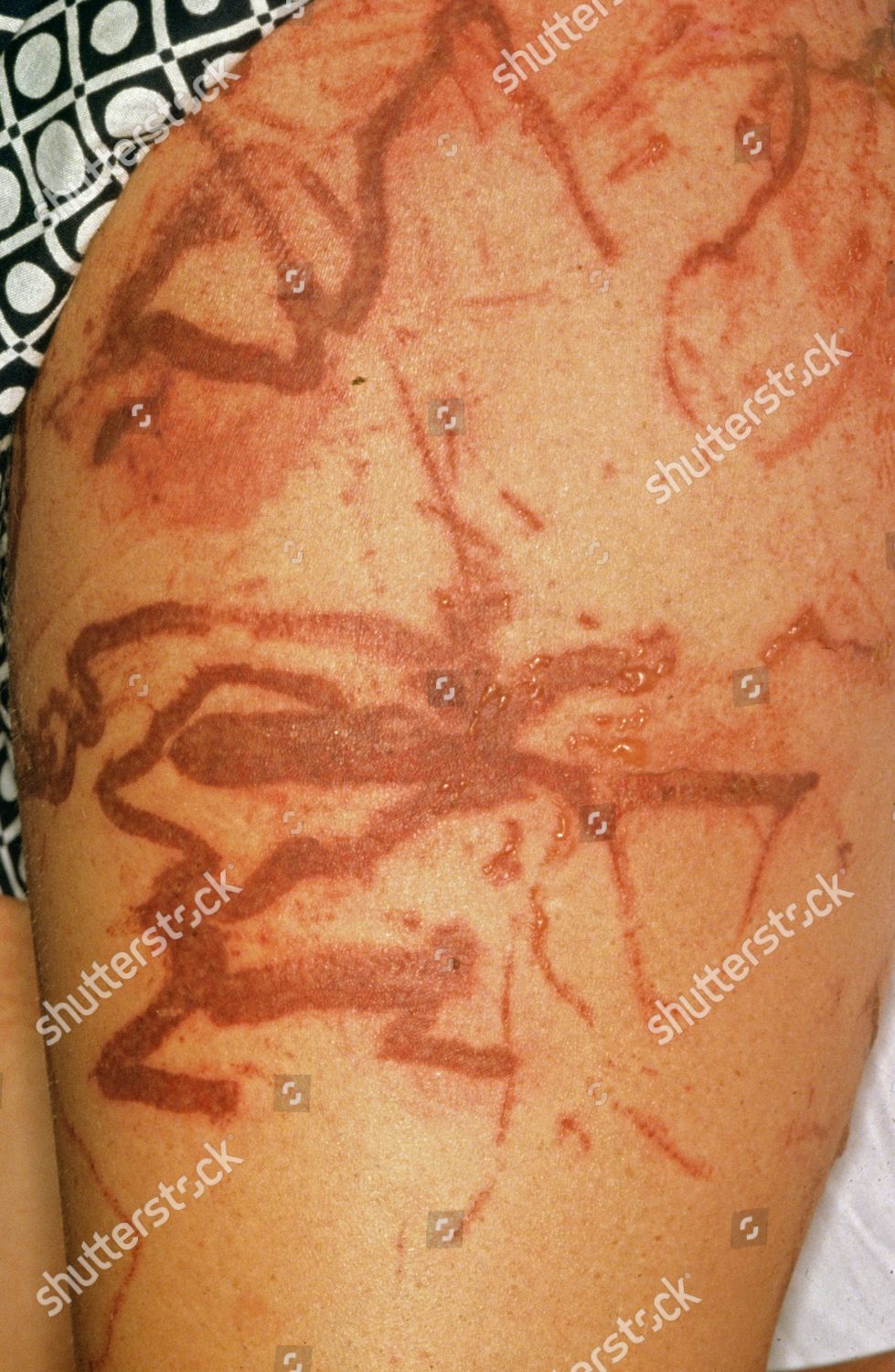 Box Jellyfish Sting Scars North Queensland Australia Editorial Stock Photo Stock Image Shutterstock