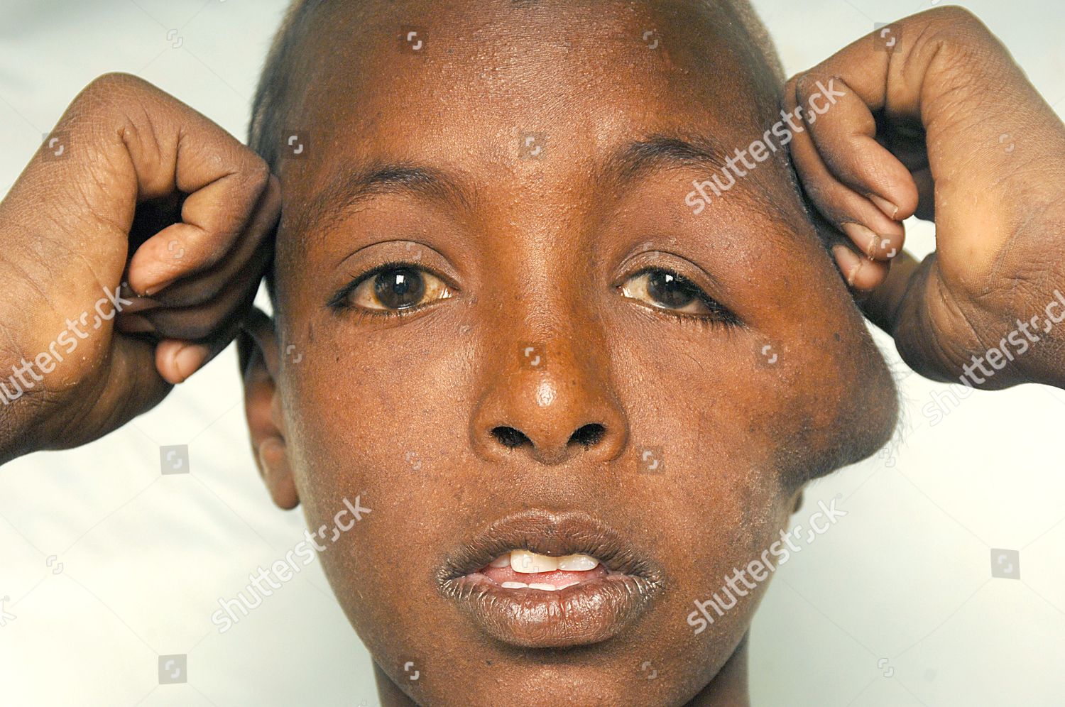 Model Released 13 Year Old Boy Suffering Foto Editorial En Stock Imagen En Stock Shutterstock