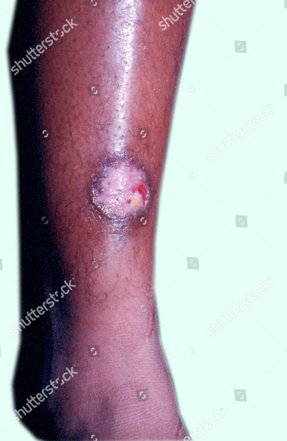 Patient Has Infected Venous Leg Ulcer Editorial Stock Photo Stock