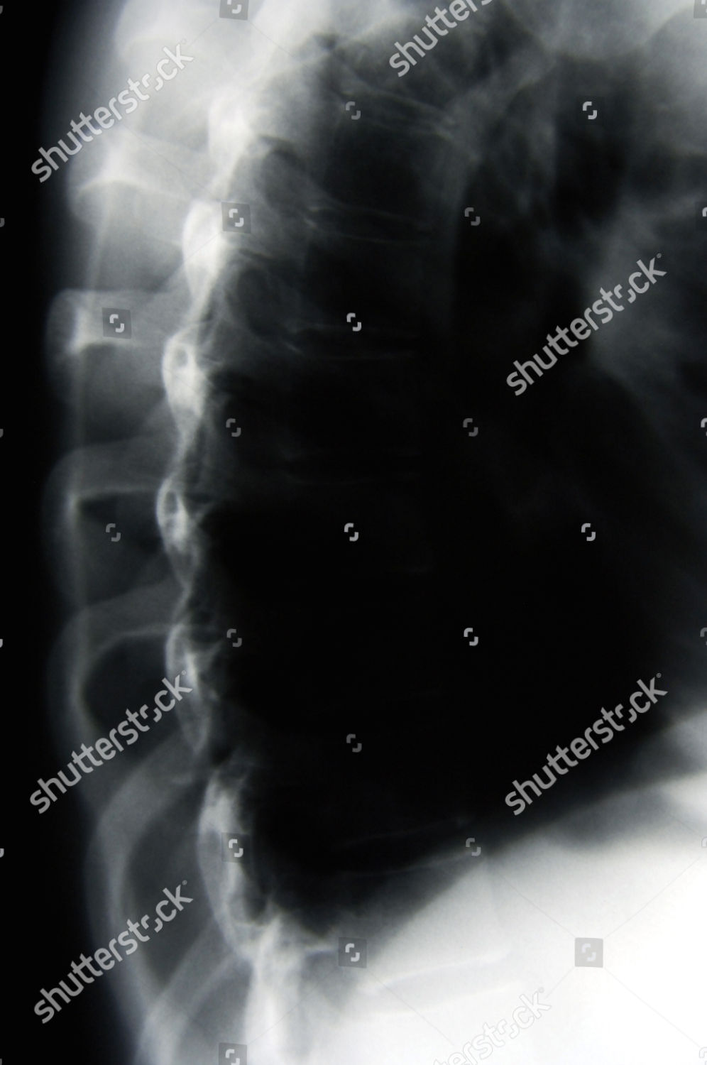 Side Xray View Rib Cage Editorial Stock Photo Stock Image Shutterstock