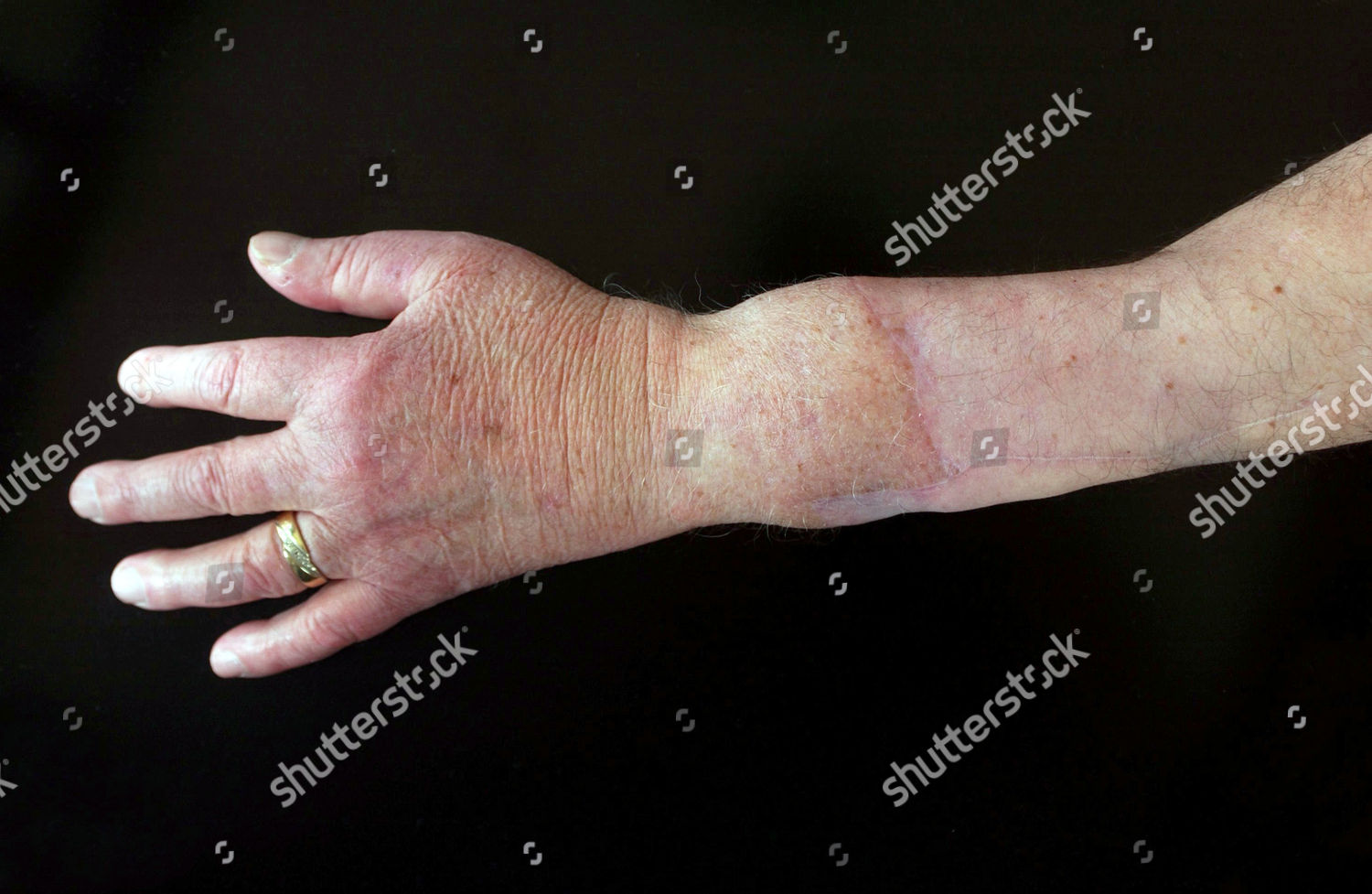 Hand Transplant Editorial Stock Photo Stock Image Shutterstock