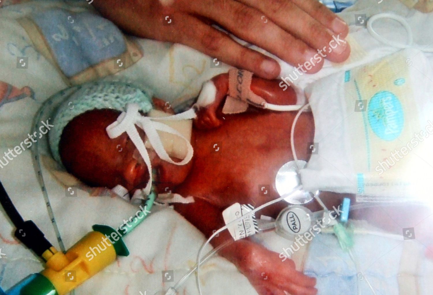 premature twins 24 weeks