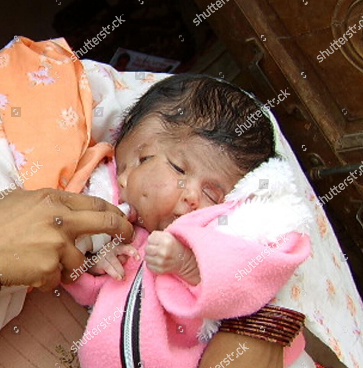 Baby Born With Two Faces Baby Born With Two Faces