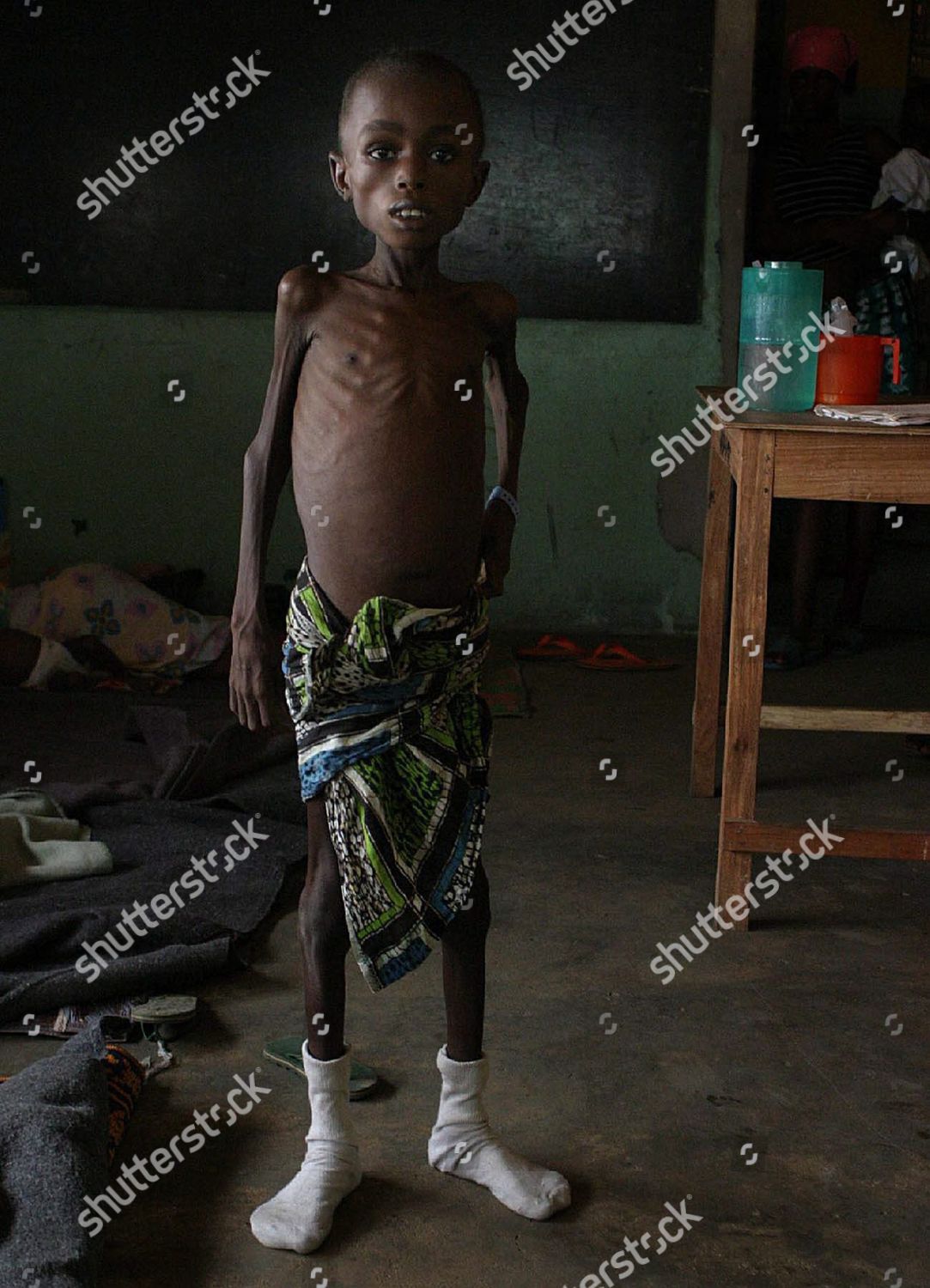 Young Liberian Boy Suffering Kwashiorkor Word Editorial Stock Photo 