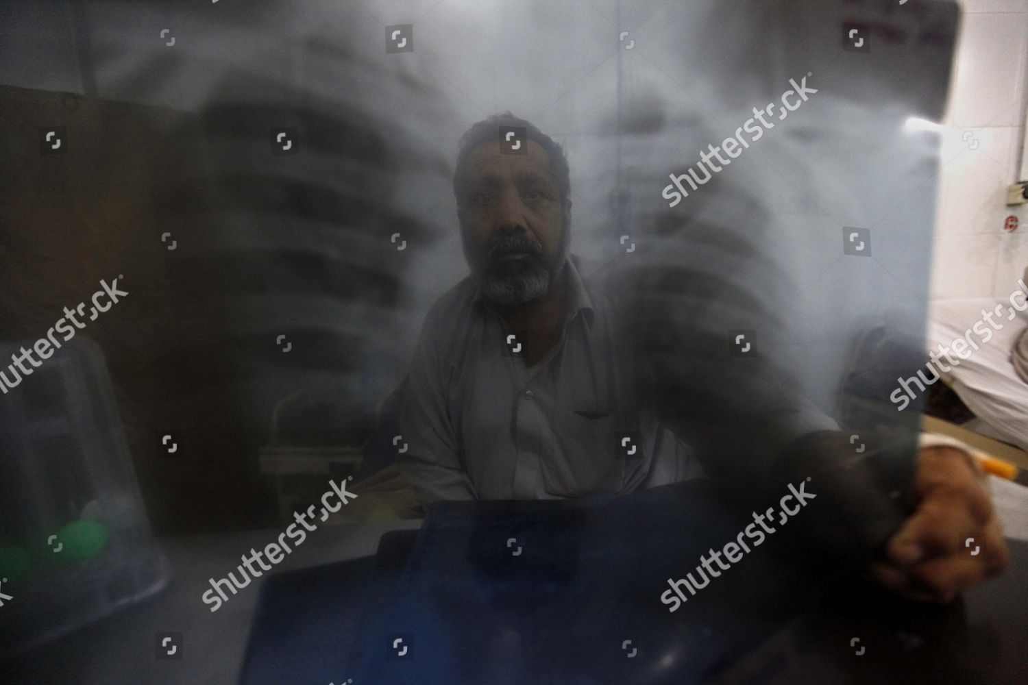 Patient Suffering Tuberculosis Tb Looks His Editorial Stock Photo