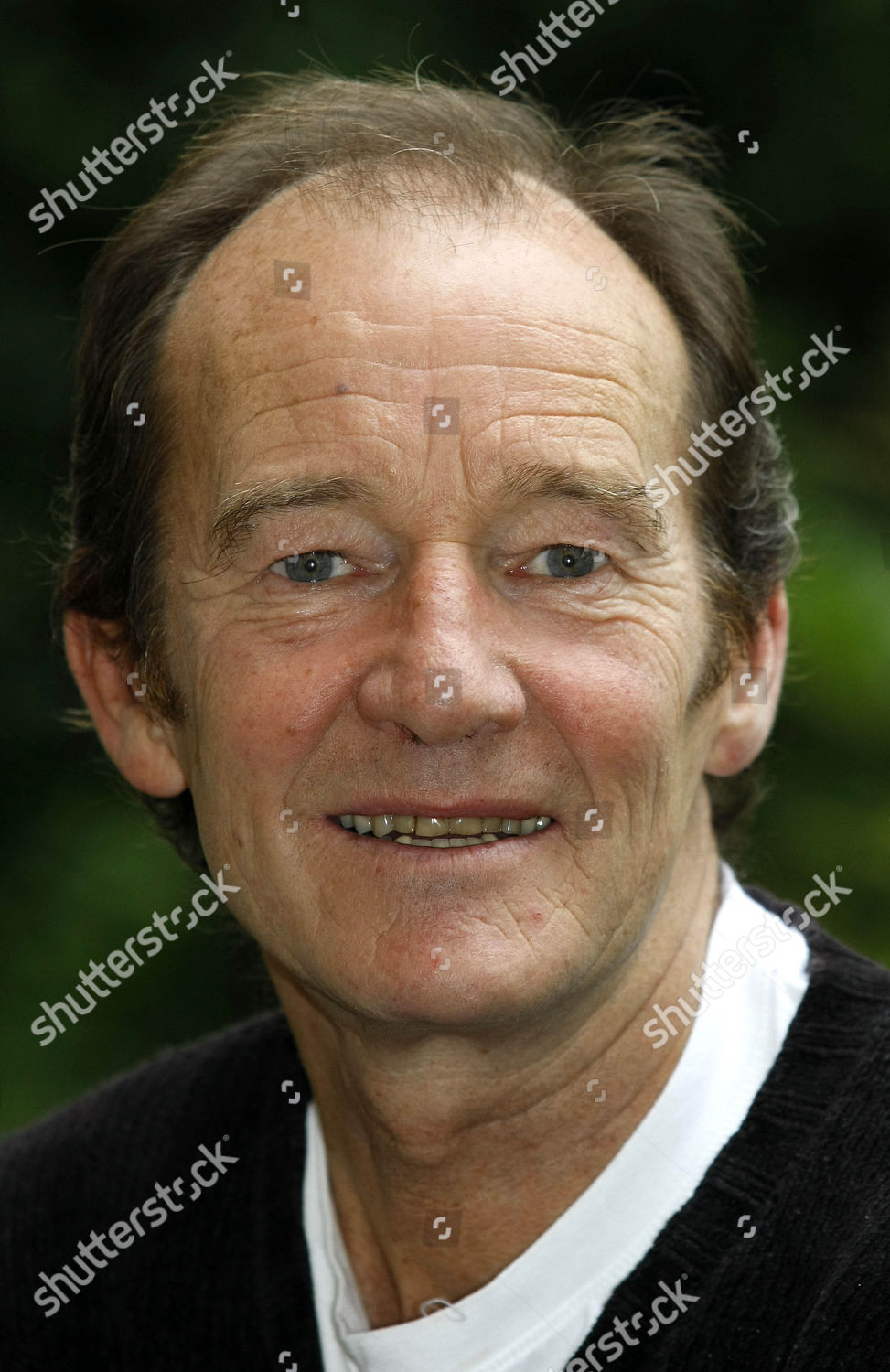 David Hayman facial scar