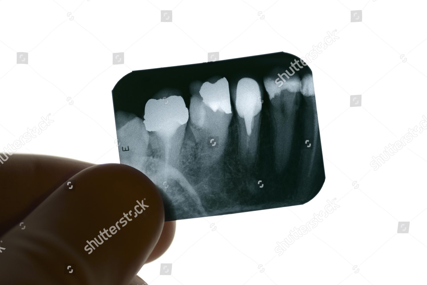 Model Released Dental Xray Being Examined Editorial Stock Photo - Stock ...