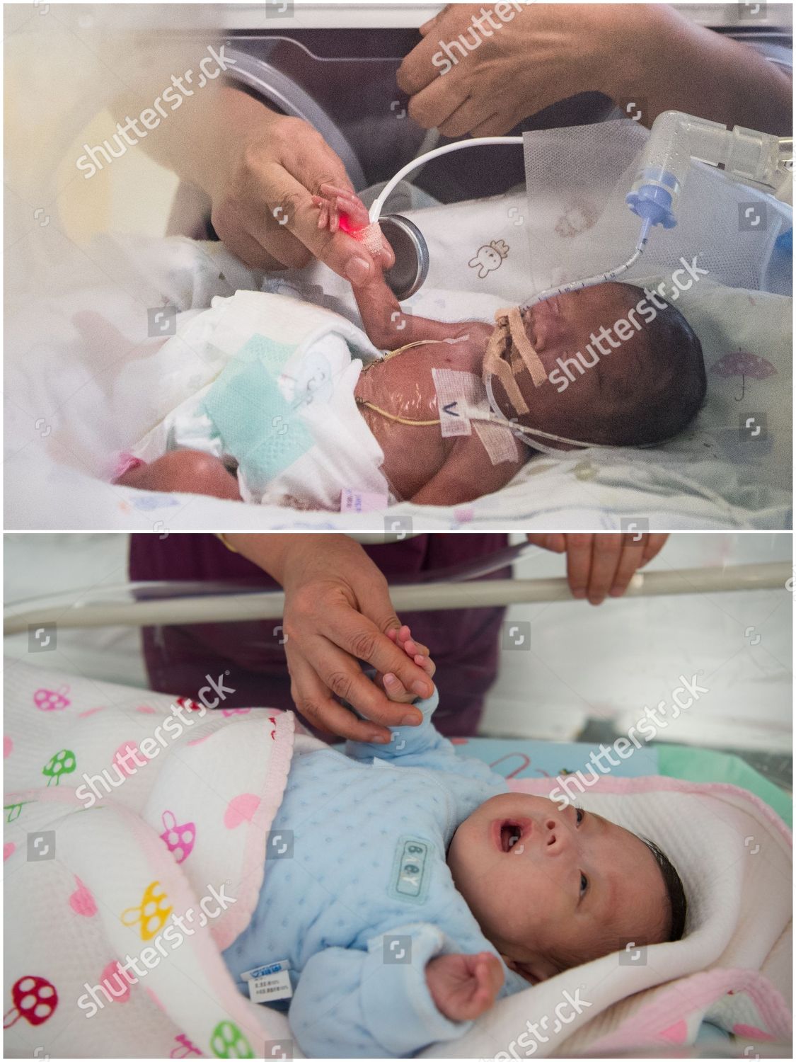 Palm Baby Born After 24 Week Gestation Editorial Stock Photo Stock Image Shutterstock