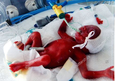 premature twins 24 weeks