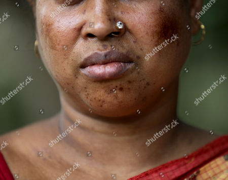 Indian Villager Bisakha Das 40 Shows Arsenicosis Editorial Stock Photo Stock Image Shutterstock